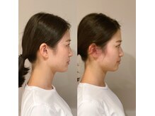 小顔22 ボルティ 赤坂支店(Bolty)/20代：小顔シンメトリー（1回）