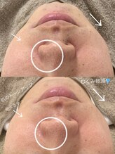 ニコ(25)/ラミピール