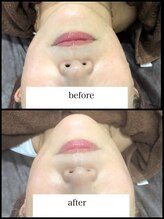 エクリル(Eclire)/小顔/フェイスライン