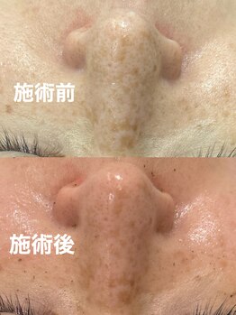 ツール(TOOL)/ハーブピーリング