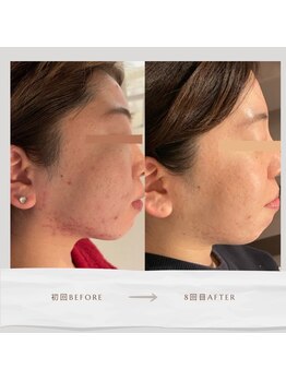 ライフサロン 別府(Life Salon)/ハーブピーリング