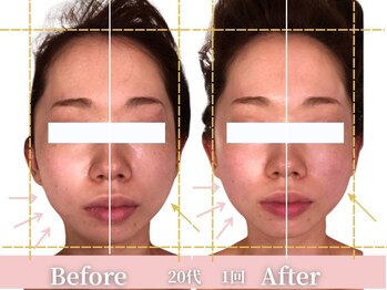 アメリイ 百合ヶ丘 新百合ヶ丘(Amerii)/小顔矯正20代挙式撮影に歪み改善