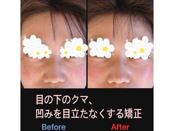 美容矯正サロン レレポノ(LELEPONO)/目の下のクマ凹み矯正