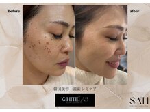 サン パーソナル ビューティー(SAN PERSONAL BEAUTY)の雰囲気（あらゆるシミに対応!1週間で剥がす最先端シミケア登場！）