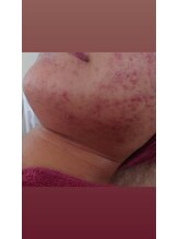 サロンエム(Salon m)/ニキビケア