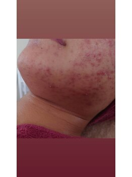 サロンエム(Salon m)/ニキビケア