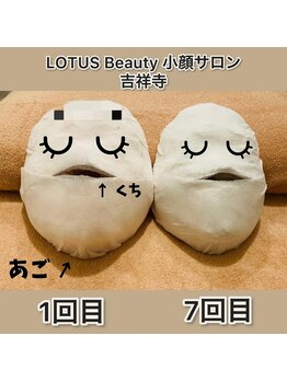 ロータス ビューティー(LOTUS Beauty)/石膏パックでお顔の変化を確認☆