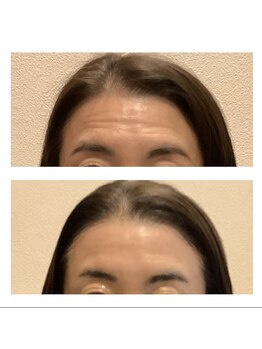 アクア エステティコ 亀有(ACQUA estetico)/シリカニードルピーリング前後