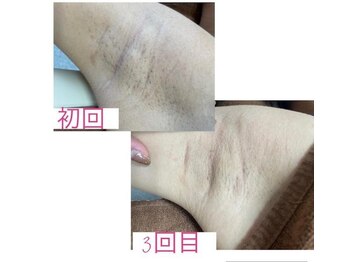 ナナラ(nanala)/女性脇脱毛効果