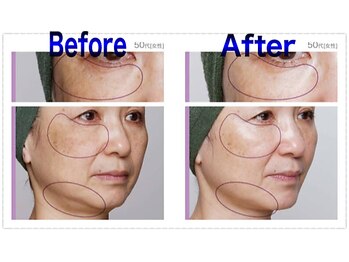 フィオーレ/☆毛穴洗浄マシン導入♪