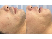 ラクーン(RACCOON)/