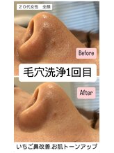 エミナル(EMINARU)/毛穴洗浄フルコース！徹底板！