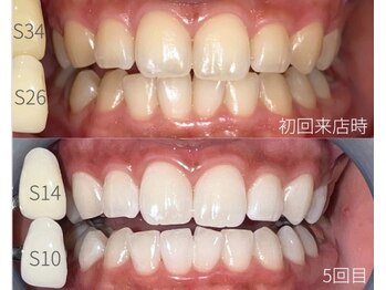 ペルレ(Perl)/本格ホワイトニング5回終了後