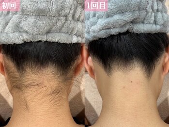 エピア 半田店(Epia)/うなじ襟足【シェービング付】