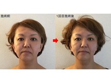 整体院プラスの雰囲気（小顔矯正1回施術後の写真です。）