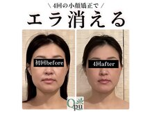小顔矯正専門サロンQpu下関店【キュープ】の雰囲気(施術後は、小顔だけでなく、顔の左右バランスも均等に!)