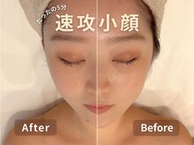 【サーマリフト】最新小顔施術◎1回の施術で速攻小顔！