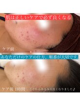 アンテイン チル(anthein chill)/細胞鎮静フェイシャル