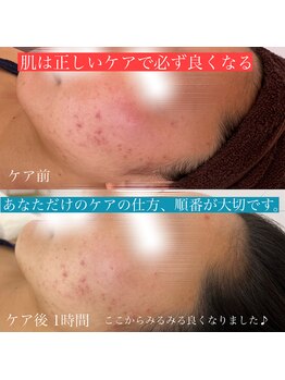 アンテイン チル(anthein chill)/細胞鎮静フェイシャル