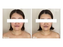 メルシートータルビューティー(MERCI)/40代からのたるみケア