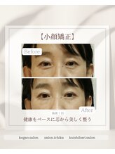 イチカ 仙川店( ichika)/目の下の血流改善(お悩み：クマ)