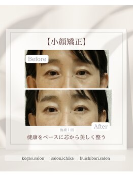 イチカ 仙川店( ichika)/目の下の血流改善(お悩み:クマ)