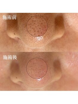 マニス(MANIS)の写真/毛穴の黒ずみ・ザラつき・白い皮脂・メイク崩れに！毛穴エクストラクションと極上マッサージでつるん肌へ♪
