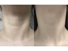 エミュ(emu)/水光美肌　beforeafter写真2