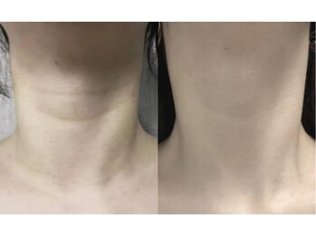 エミュ(emu)/水光美肌　beforeafter写真2