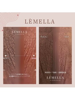 マリナビューティーサロン(Malina BEAUTY SALON)の写真/【★韓国ルメラ×デリケートゾーン】下着のスレ・摩擦による鼠蹊部やIゾーンを黒ずみを清潔なピンク肌へ