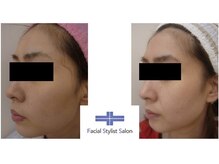 フェイシャルスタイリストサロン 高崎店(Facial Stylist Salon)/ケア例（25）