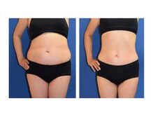 カブール 姫路店/皮下脂肪の改善エンダモロジー☆