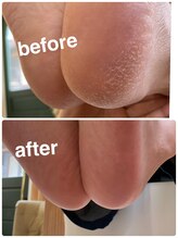 リットネイル(Lit nail)/すべすべ角質ケア