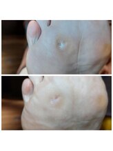 爪切り屋 足楽/魚の目１つだけお悩みの方は