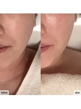 エムベル(M.belle)/リフトアップマッサージ施術前後