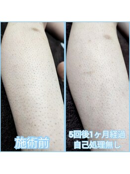 マイセルフ(myself)/足脱毛施術例：20代
