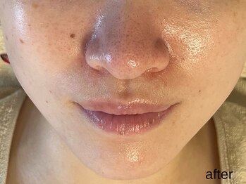 サロン ド エメ(salon de aimer)/【After】毛穴縮小 本格毛穴改善