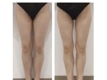 レミュー/下半身太りもすらっと美脚へ