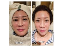 アン 銀座(ann)/レモンボトルとエクソソーム