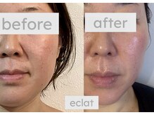 エクラ 五反田(eclat)/小顔もおまかせください♪