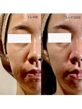 カルナ(CARNA)/ほうれい線アプローチににも◎