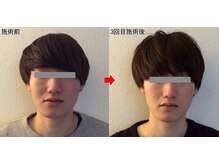 整体院プラスの雰囲気（小顔矯正3回施術後の写真です。）