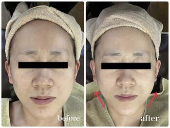 ジャスミン(Jasmin)/マイクロキャビ×RF×脂肪分解