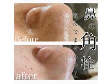 グレイティア(gratia)の雰囲気（美容液で贅沢毛穴クレンジング♪毛穴洗浄¥6800～）