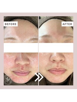 ハルミハーブピーリング 池袋店(Harumi Herb Peeling)/