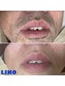 【男性脱毛】結果に自信！大人気！ヒゲ脱毛お試し！一箇所¥1650