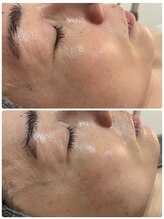 シェルビー(Cielbe.)/エクソソームエステ