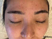 サロン ド エメ(salon de aimer)/【Before】赤み、開き毛穴に！