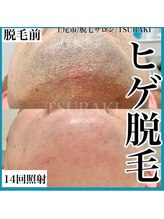 ツバキ(TSUBAKI)/ヒゲ脱毛