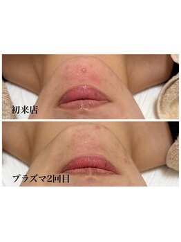 キーオブフェイス(Key of Face)/お悩み【ニキビ+赤味】